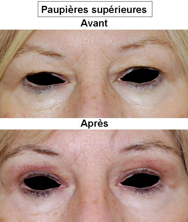 Fotoepilyatsiya et laser epilyatsiya sur la personne