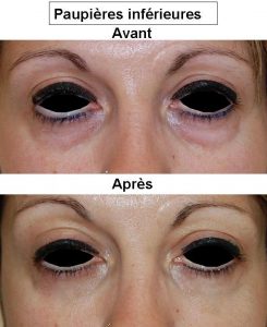 Chirurgie des paupières Lyon : Dr Bayol, blépharoplastie à Chirurgie des paupières Lyon : Dr Bayol, blépharoplastie à