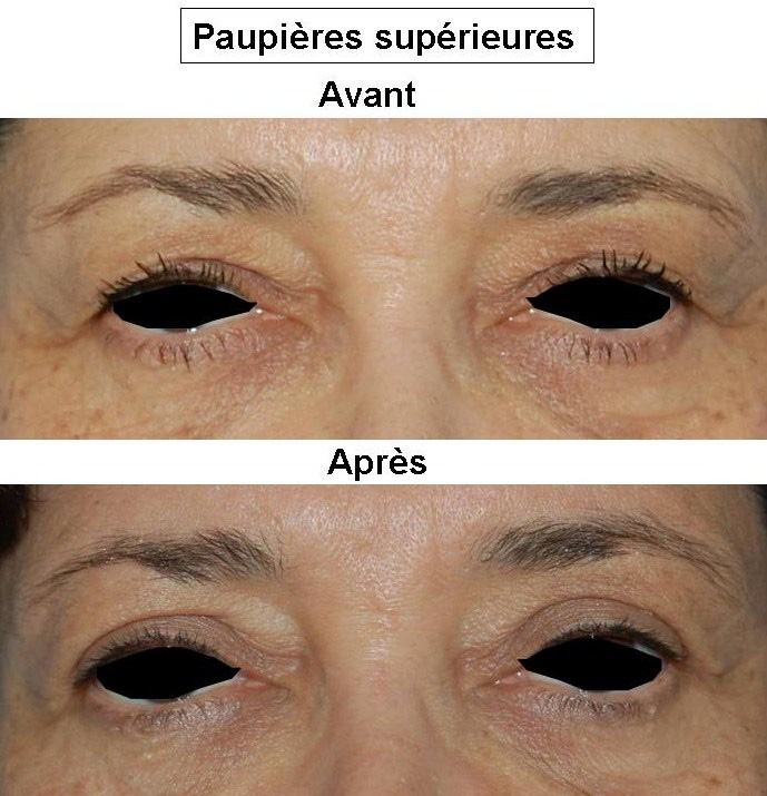 Le rajeunissement de la personne après 65