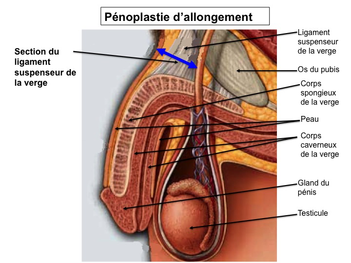 Allongement Penis 42