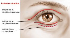 Incisions cutanées pour la blepharoplastie