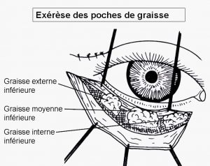 Exérèse des poches de graisse