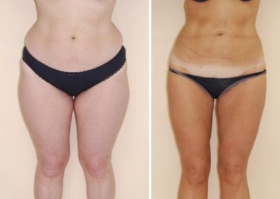 Lipoaspiration : cas n° 1