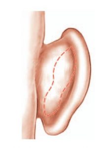 cicatrice otoplastie