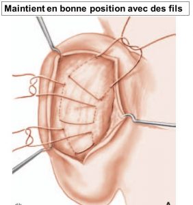 Points de suture otoplastie