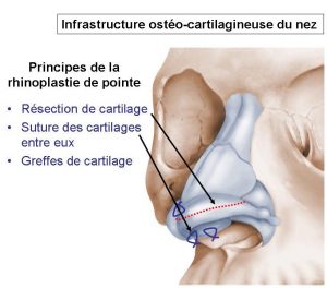 rhinoplastie pointe