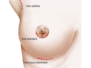Voies des implants mammaires à Lyon