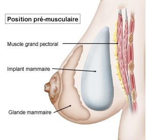 Implant mammaire pré-musculaire à Lyon