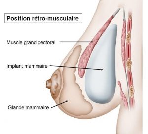 Prothèse rétro-musculaire