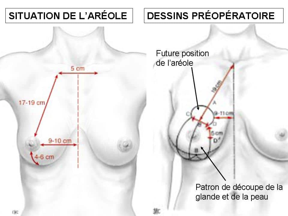 plastie de réduction mammaire Lyon