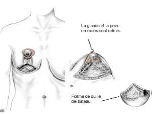 réduction mammaire Lyon