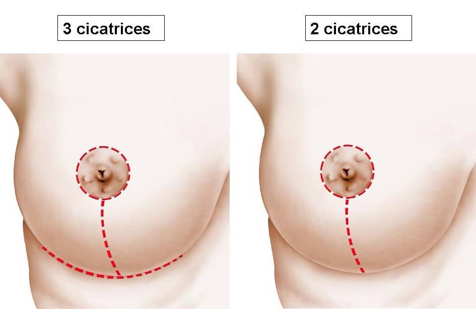 cicatrices de plastie mammaire de réduction Lyon