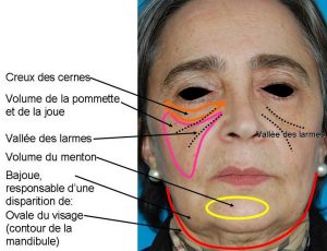 Dépressions (creux) ou manques de volume
