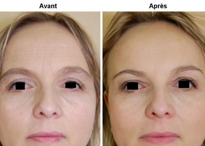 injection botox Lyon