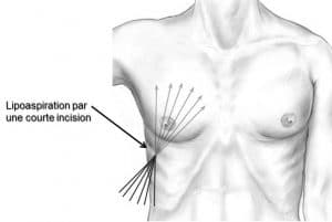 liposuccion gynécomastie Lyon