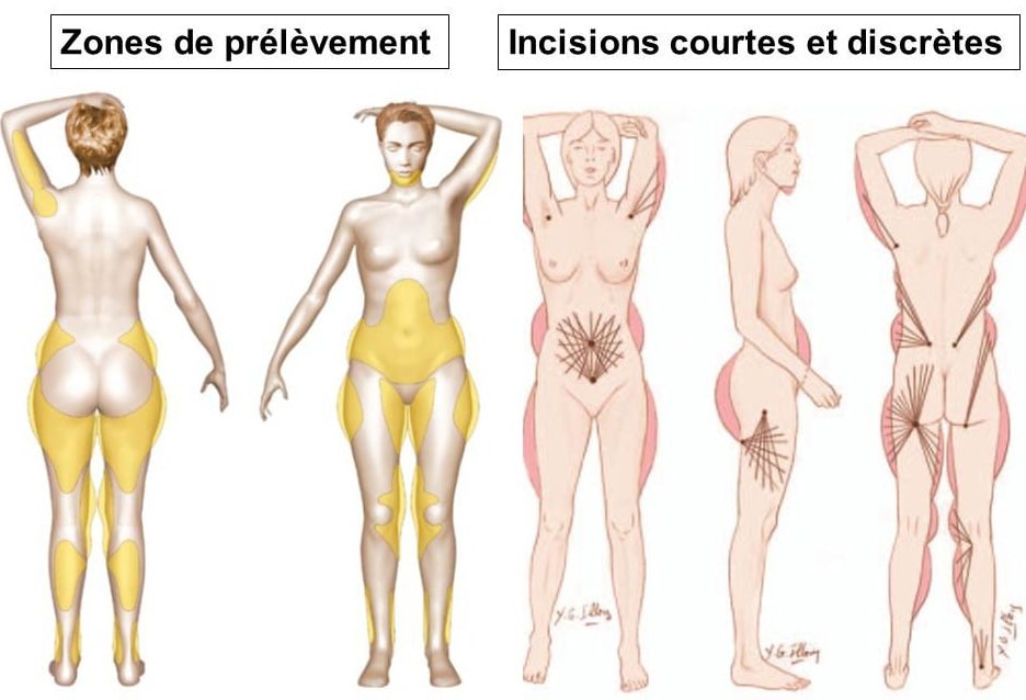 liposuccion avant lipostructure des seins à Lyon