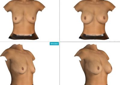Logiciel simulation 3D chirurgie esthétique