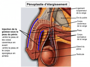 pénoplastie d'élargissement Lyon