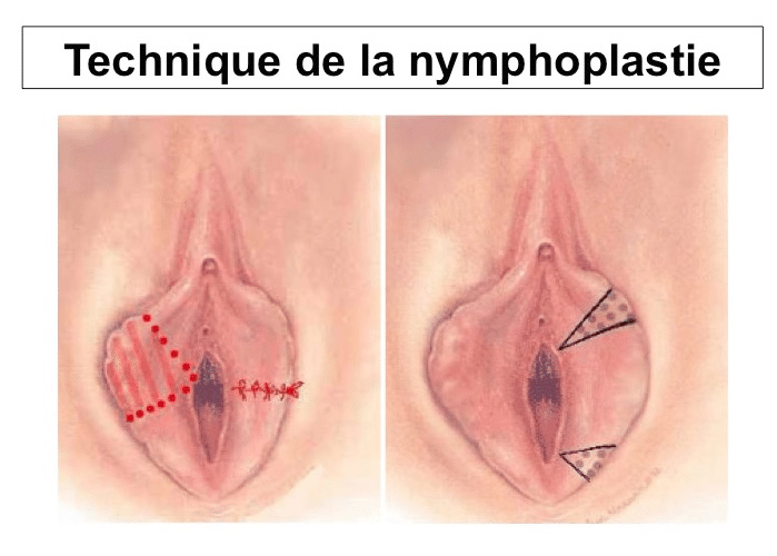 nymphoplastie de réduction Lyon