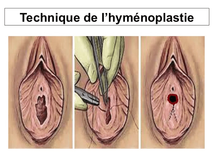 hyménoplastie Lyon