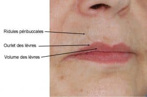 Injection acide hyaluronique lèvres Lyon