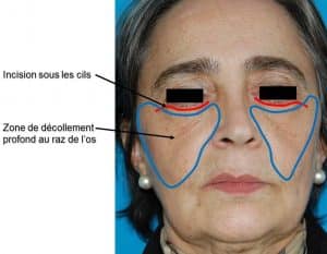 Incision et décollement lifting centro-facial