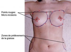 lipofilling mammaire Lyon