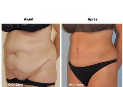 abdominoplastie