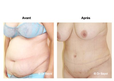 abdominoplastie Aix-les-Bains