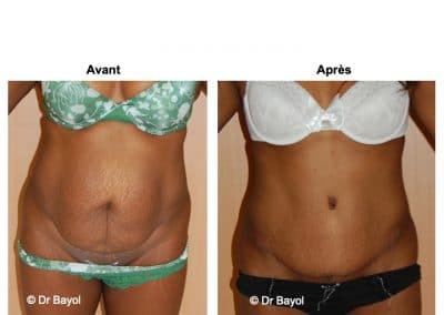 abdominoplastie Lyon