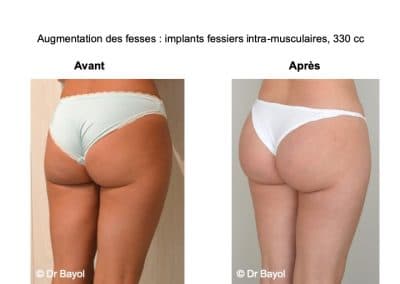 augmentation des fesses par prothèses et implants fessiers Lyon