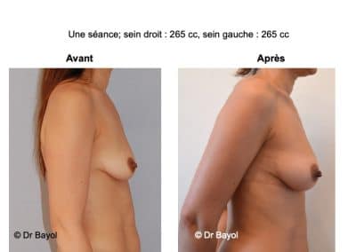 augmentation mammaire sans prothèses Aix-les-Bains