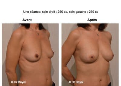 augmentation mammaire sans prothèses Lyon