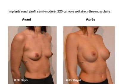 augmentation poitrine Lyon