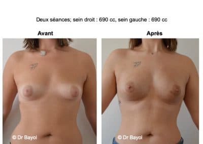 augmentation mammaire sans implants Aix-les-Bains