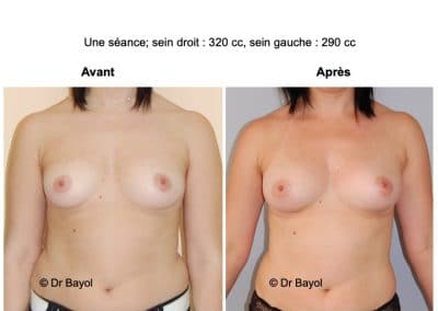 augmentation mammaire sans implants Annecy