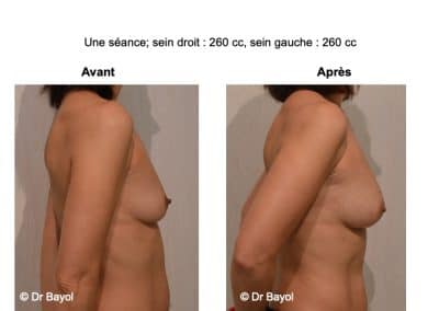 augmentation mammaire sans implants Lyon