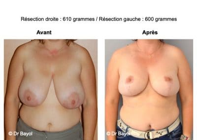bon chirurgien réduction mammaire Aix-les-Bains