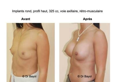 chirurgie esthetique poitrine Lyon