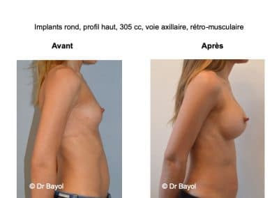 chirurgie esthétique implants mammaires Lyon