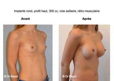 chirurgie esthétique prothèses mammaires Lyon