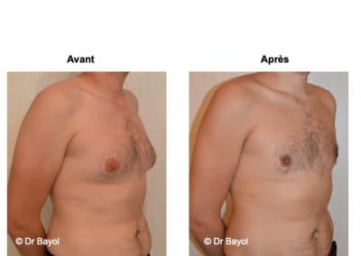 cure de gynecomastie Lyon