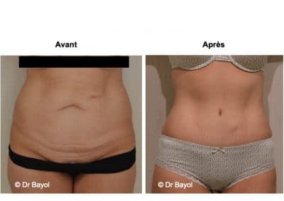 dermolipectomie abdominale