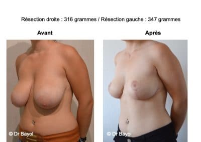 hypertrophie mammaire Grenoble
