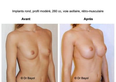 implants mammaires Aix-les-Bains