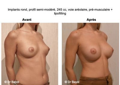 implants mammaires Lyon