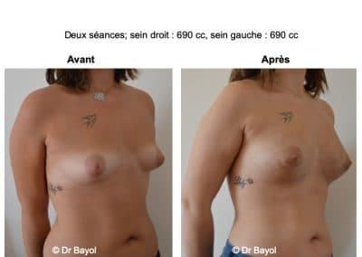 injection de graisse dans les seins Aix-les-Bains