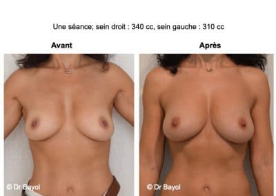 injection de graisse dans les seins Lyon