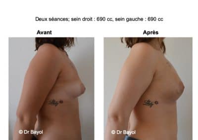 injection de graisse seins Aix-les-Bains