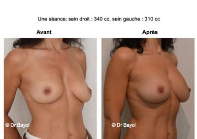 injection de graisse seins Lyon